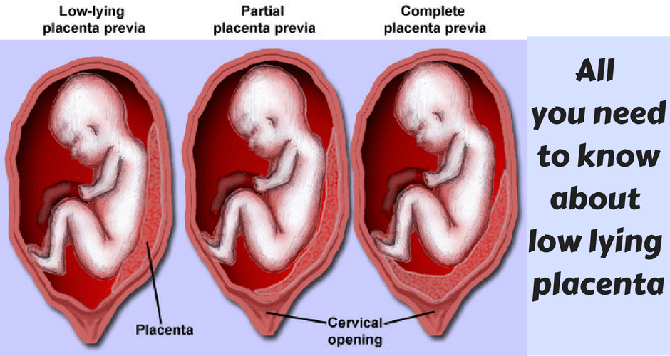 Is Low Lying Placenta Normal In Early Pregnancy