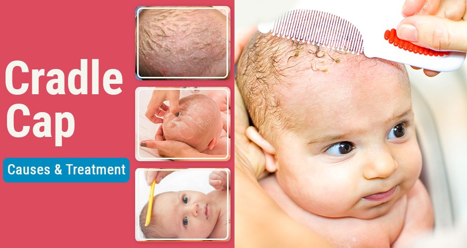 All you Need to Know about Cradle Cap in Babies