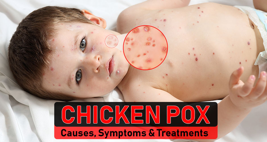Chicken pox symptoms