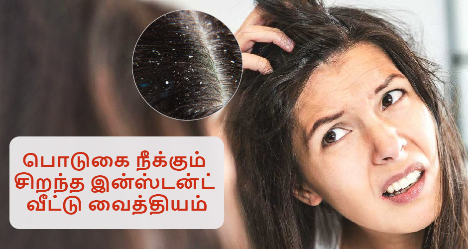 பொடுகை முற்றிலுமாகப் போக்கும் சிம்பிள் வீட்டு வைத்தியம் | Home Remedies for  Dandruff in Tamil