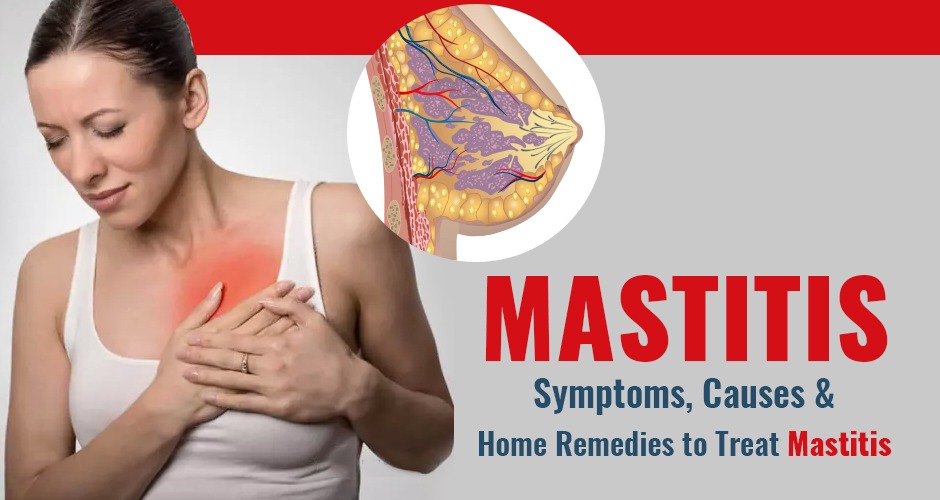 Mastitis: Symptoms, Causes, and Home Remedies to Treat Mastitis