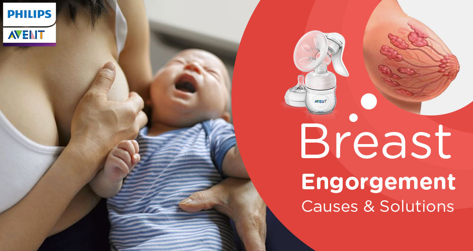 Breast Engorgement Causes And Solutions